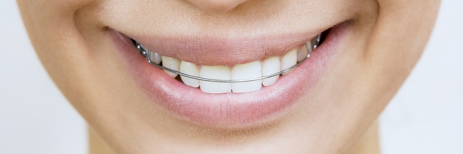 Quick Straight Braces - Purely Dental