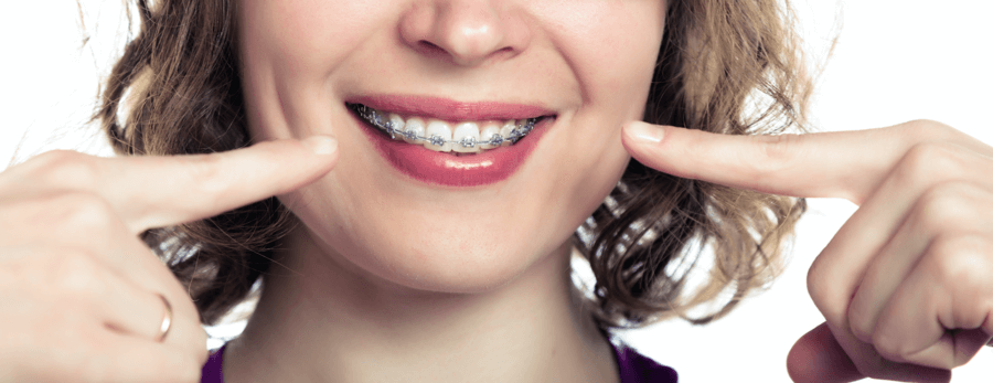 woman-with-adult-braces-1