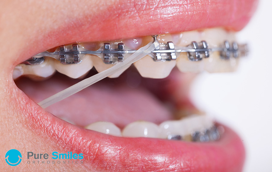 Elastics (Rubber Bands) - Olympus Pointe Orthodontics: Garri Tsibel, DDS