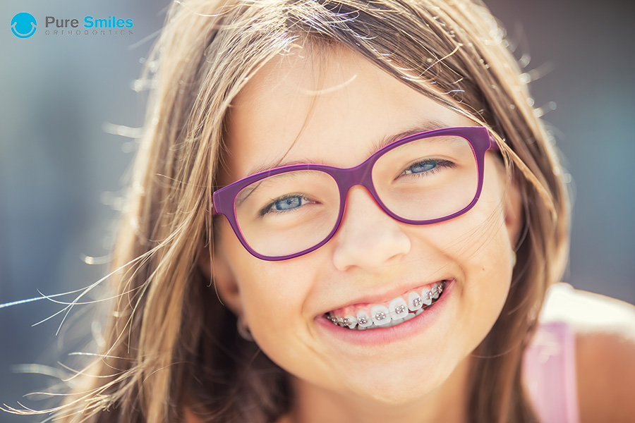 Self-Ligating Ceramic Braces: Better Orthodontic Treatment