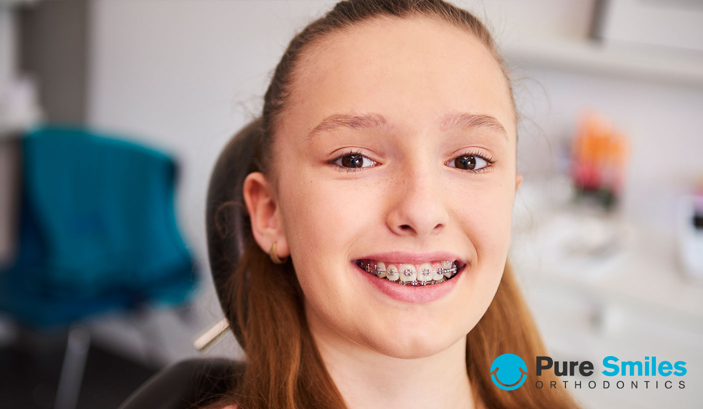 Braces - Metal at The smile mission (Up to 99% Off)