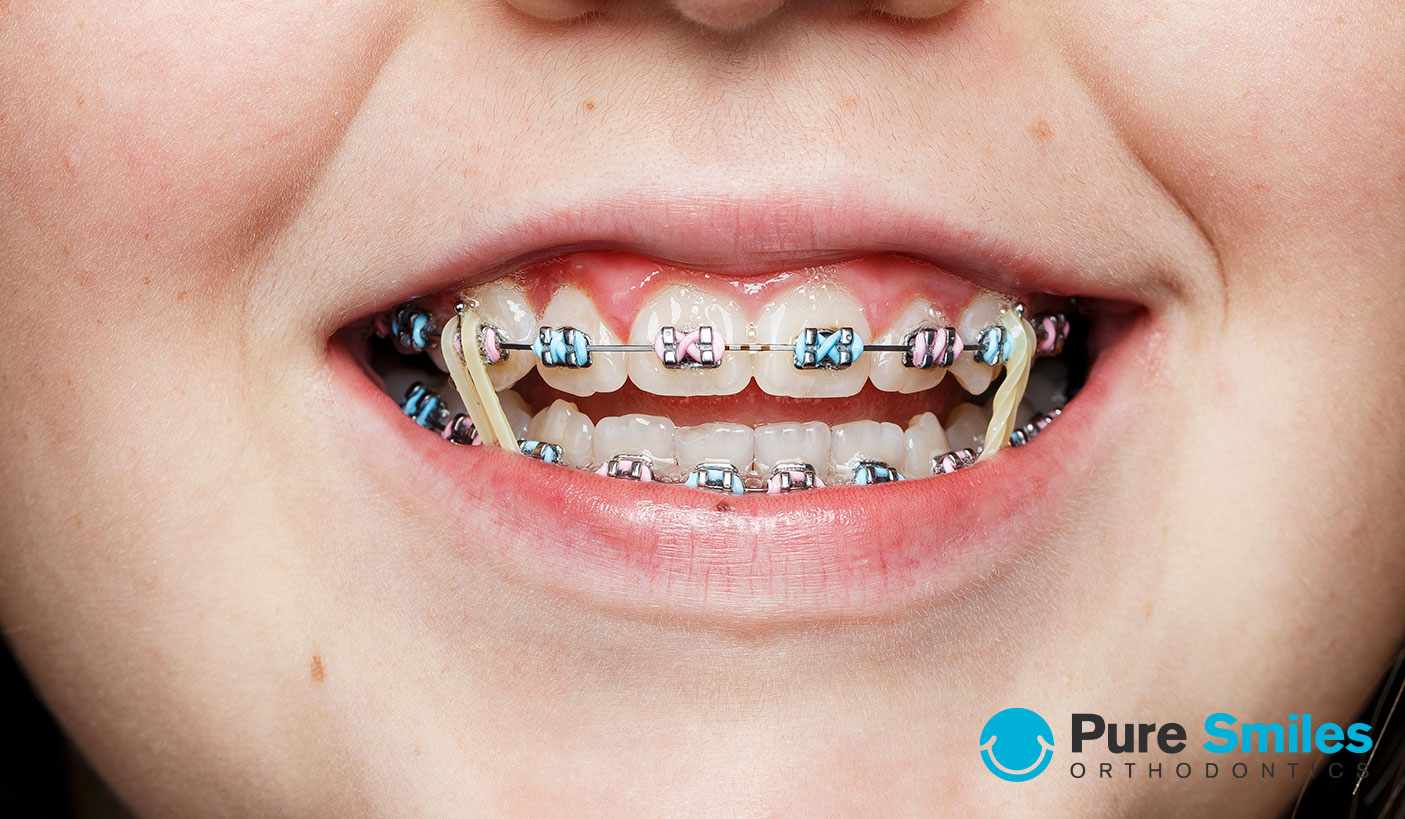 braces with rubber bands