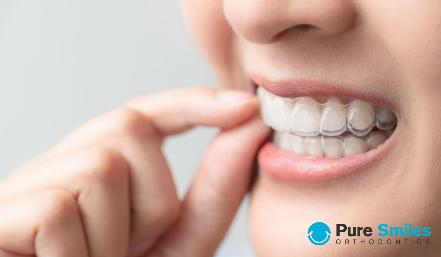 invisalign aligners pure smiles