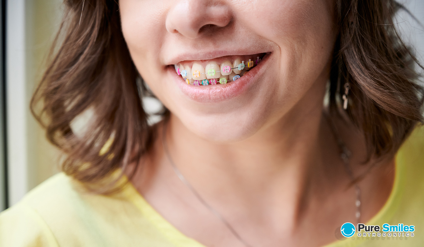 Do dental braces stain teeth?