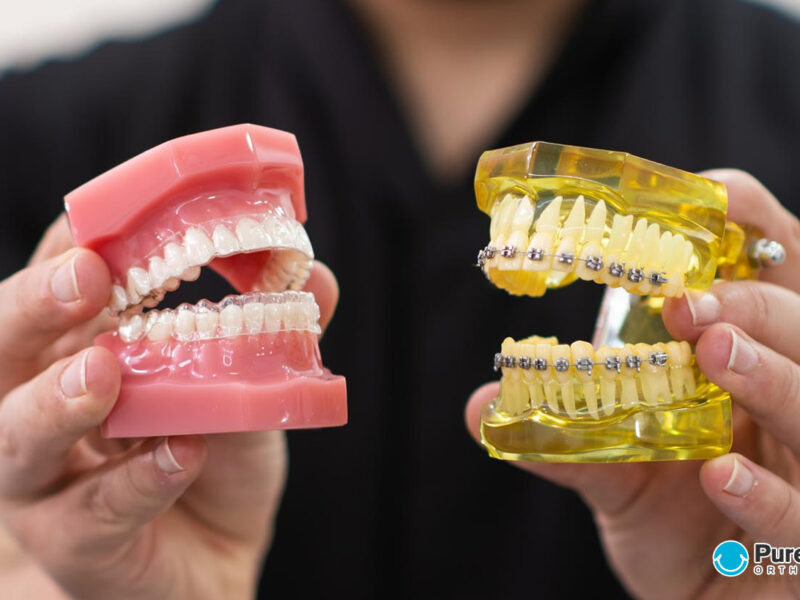 Invisalign Vs. Braces