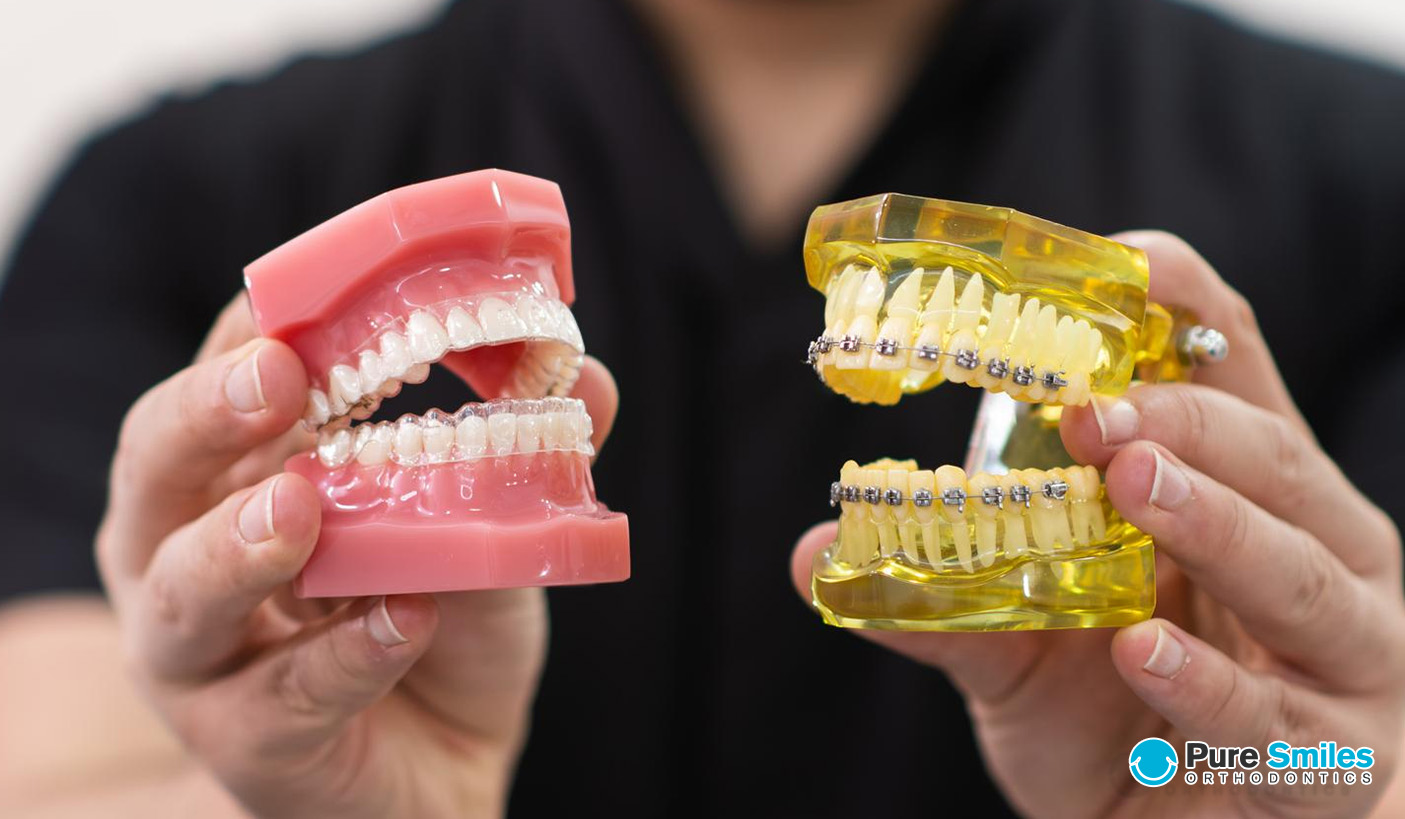 Invisalign Vs. Braces