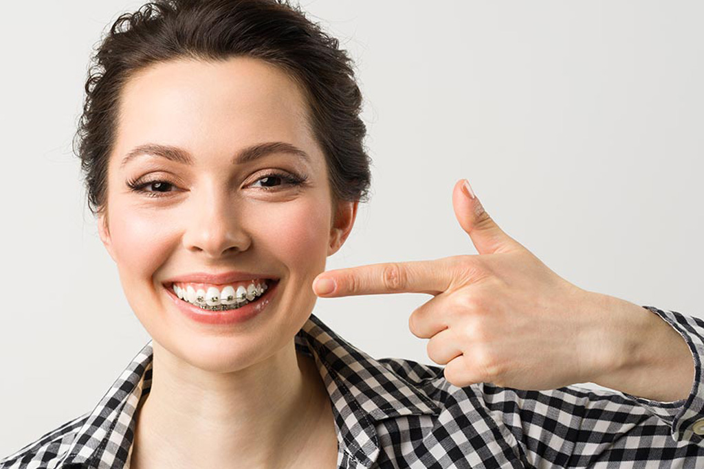 Braces-some-Important-points