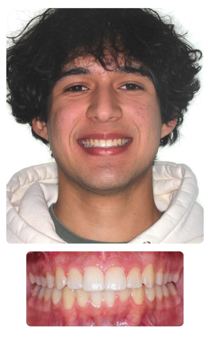Emilio After